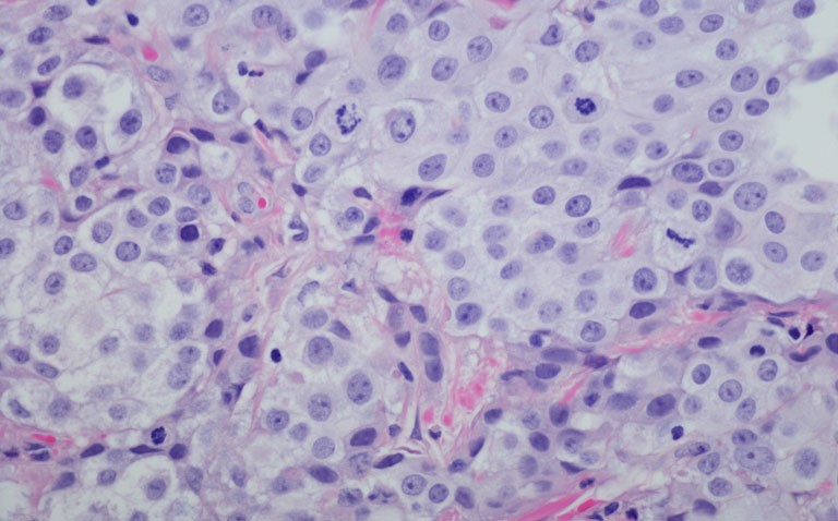 keratin 17 as a potential biomarker in bladder cancer