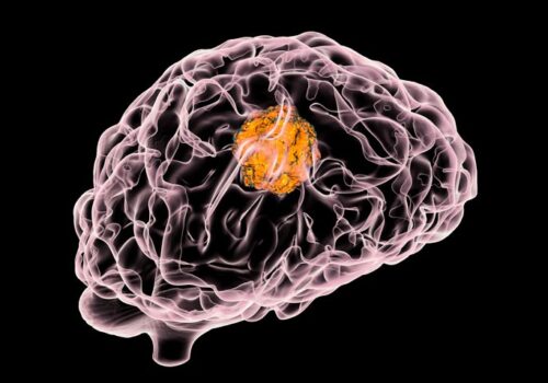 brain tumour