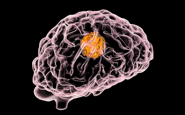 brain tumour