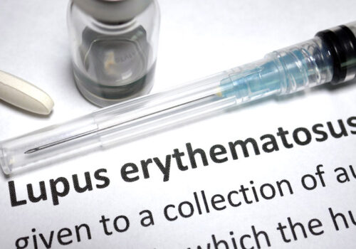 steroid use reduced in SLE|systemic lupus erythematosus