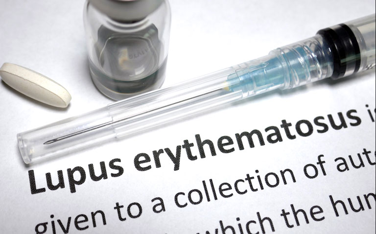 steroid use reduced in SLE|systemic lupus erythematosus