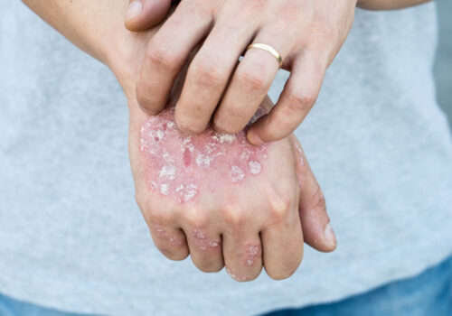 NMA and biologics in plaque psoriasis