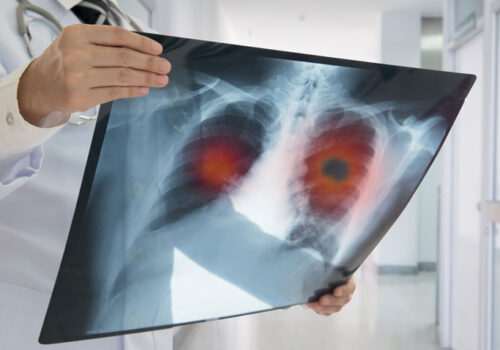 lung cancer