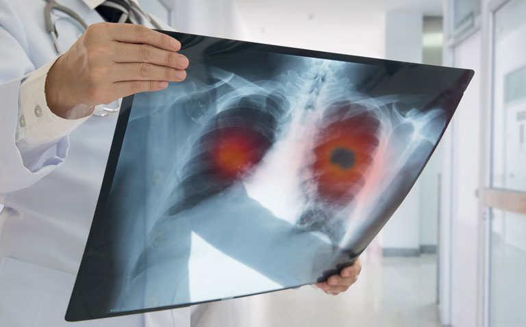 lung cancer
