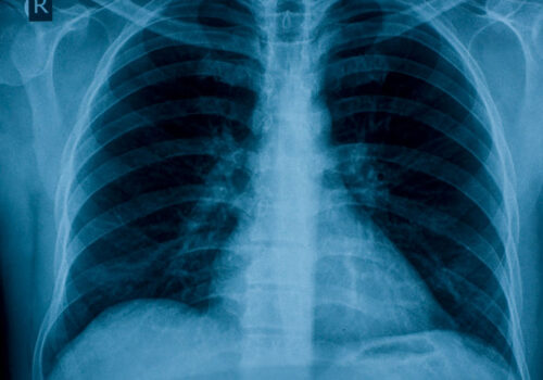 chest x-ray