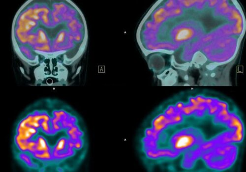 Higher tau levels in Alzheimer's seen on PET scans linked to psychosis and cognitive decline