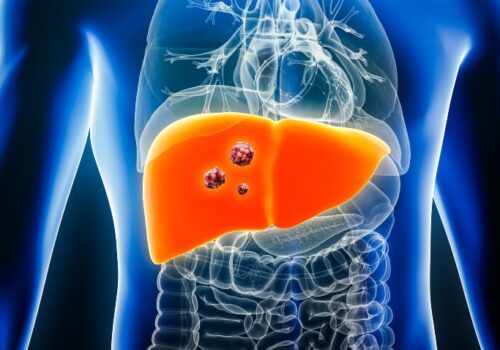 A digital illustration of a transparent human body with the organs visible and the liver highlighted in orange with tumours or cancerous cells in the middle to illustrate histotripsy for liver cancer multidisciplinary care