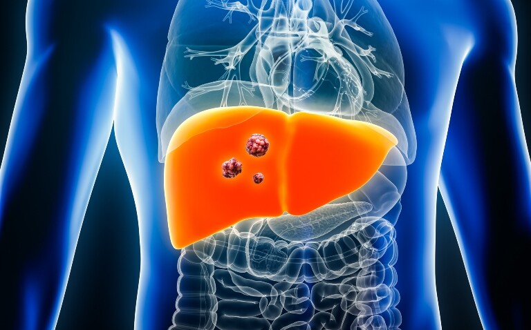A digital illustration of a transparent human body with the organs visible and the liver highlighted in orange with tumours or cancerous cells in the middle to illustrate histotripsy for liver cancer multidisciplinary care