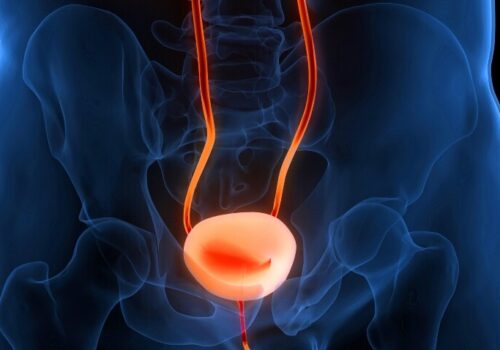 A computer generated image of a red bladder with a faded blue pelvis outline in the background to illustrate improving treatment pathways in muscle-invasive bladder cancer|A table outlining the staging conventions of non-muscle-invasive bladder cancer and muscle-invasive bladder cancer