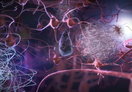 Lecanemab promising therapy for early Alzheimer's disease