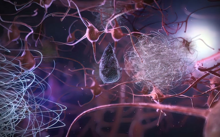 Lecanemab promising therapy for early Alzheimer's disease