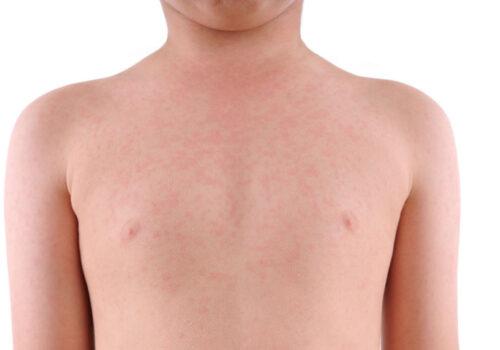 Lirentelimab effective for refractory chronic urticaria