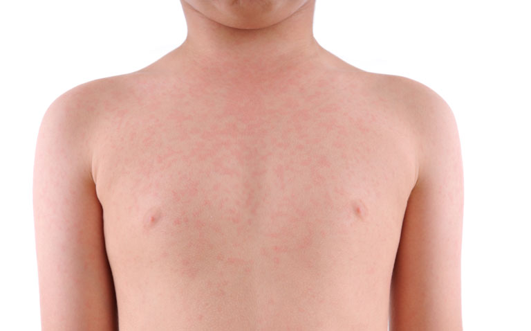 Lirentelimab effective for refractory chronic urticaria