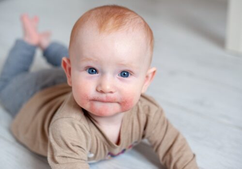 A baby lying on its front on the floor looking at the camera with visible atopic dermatitis on its face around its mouth to illustrate the long-term benefits of dupilumab in paediatric severe atopic dermatitis