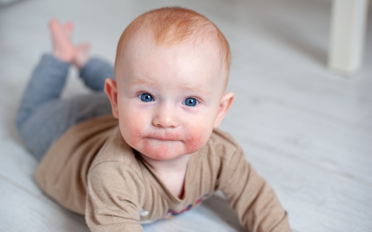A baby lying on its front on the floor looking at the camera with visible atopic dermatitis on its face around its mouth to illustrate the long-term benefits of dupilumab in paediatric severe atopic dermatitis