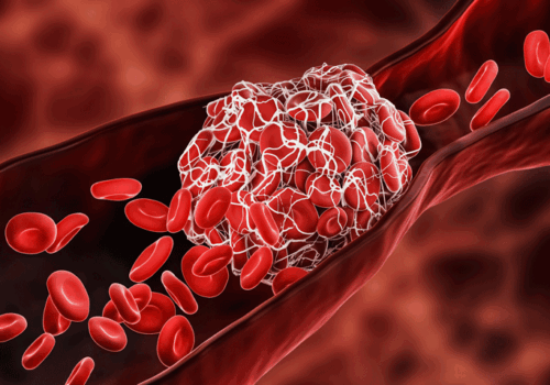 Longer rivaroxaban course reduces risk of recurrent venous thromboembolism