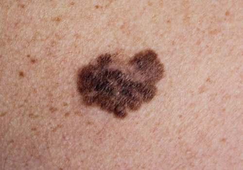 Low vitamin D levels linked to worse overall survival in invasive melanoma