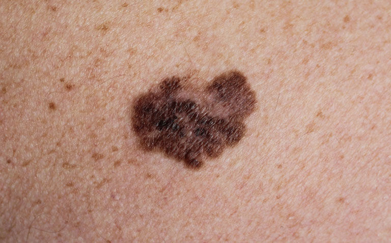 Low vitamin D levels linked to worse overall survival in invasive melanoma