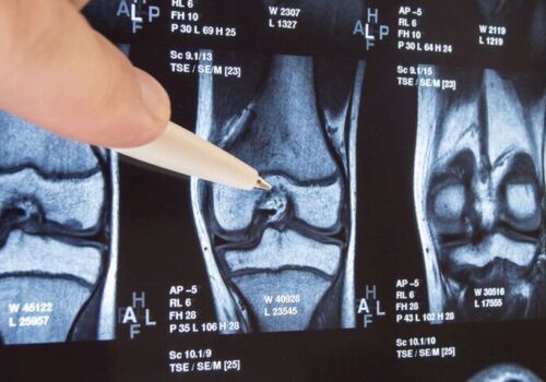 MRI study suggest NSAIDs may worsen arthritis inflammation|MRI study suggest NSAIDs may worsen arthritis inflammation