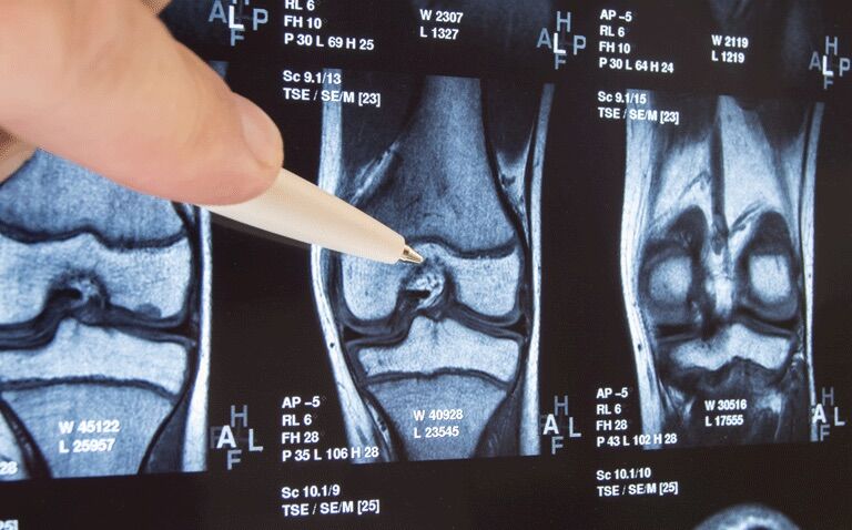 MRI study suggest NSAIDs may worsen arthritis inflammation|MRI study suggest NSAIDs may worsen arthritis inflammation