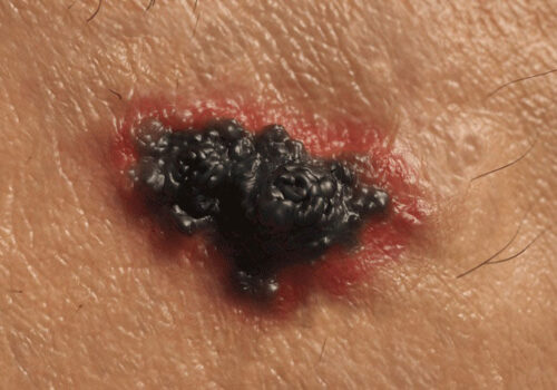 mRNA-4157/V940 vaccine effective in advanced melanoma|MRNA-4157/V940 vaccine effective in advanced melanoma