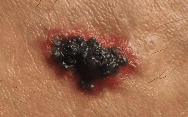 mRNA-4157/V940 vaccine effective in advanced melanoma|MRNA-4157/V940 vaccine effective in advanced melanoma