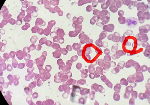 Malarial monoclonal antibody shows high efficacy at 6 months