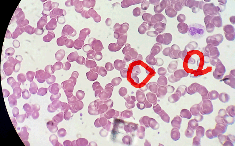 Malarial monoclonal antibody shows high efficacy at 6 months