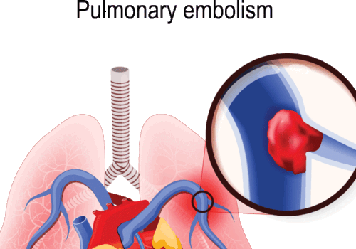 NEWS adequate for ICU and mortality predictions in acute pulmonary embolism