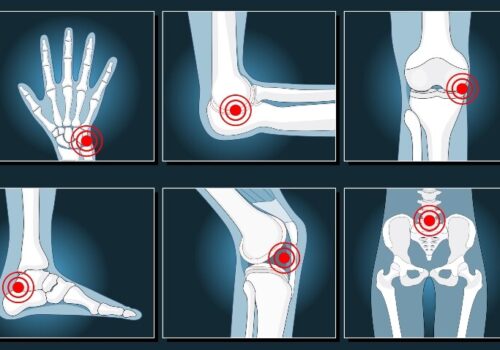Six x-ray image illustrations showing a hand