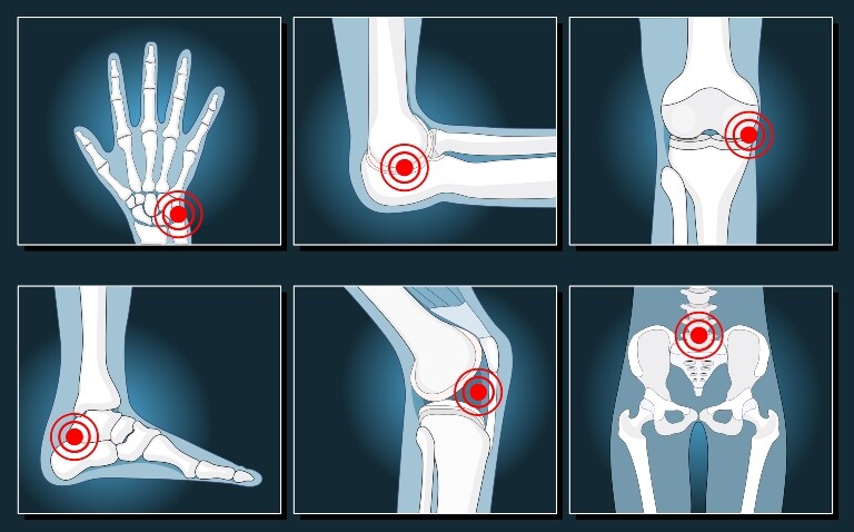 Six x-ray image illustrations showing a hand