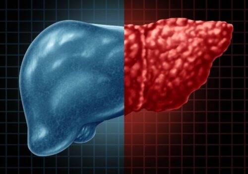 Non-invasive tests show similar prognostic value to histology for adverse outcomes in NAFDL|Non-invasive tests show similar prognostic value to histology for adverse outcomes in NAFDL