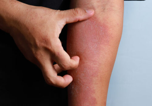 Older adults with atopic eczema at greater risk of developing Alzheimer's disease