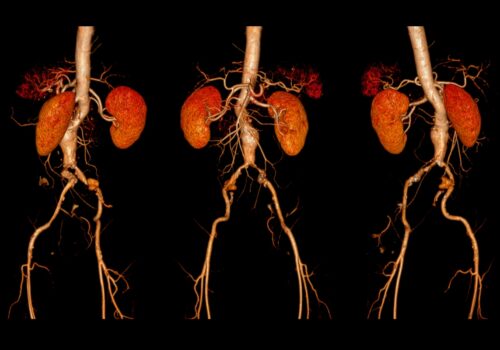 A CT angiography of the abdominal aorta to represent an abdominal aortic aneurysm and the potential of metformin as a pharmacological intervention