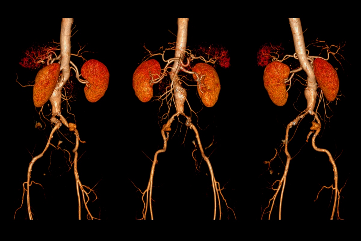 A CT angiography of the abdominal aorta to represent an abdominal aortic aneurysm and the potential of metformin as a pharmacological intervention