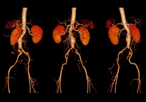 A CT angiography of the abdominal aorta to represent an abdominal aortic aneurysm and the potential of metformin as a pharmacological intervention