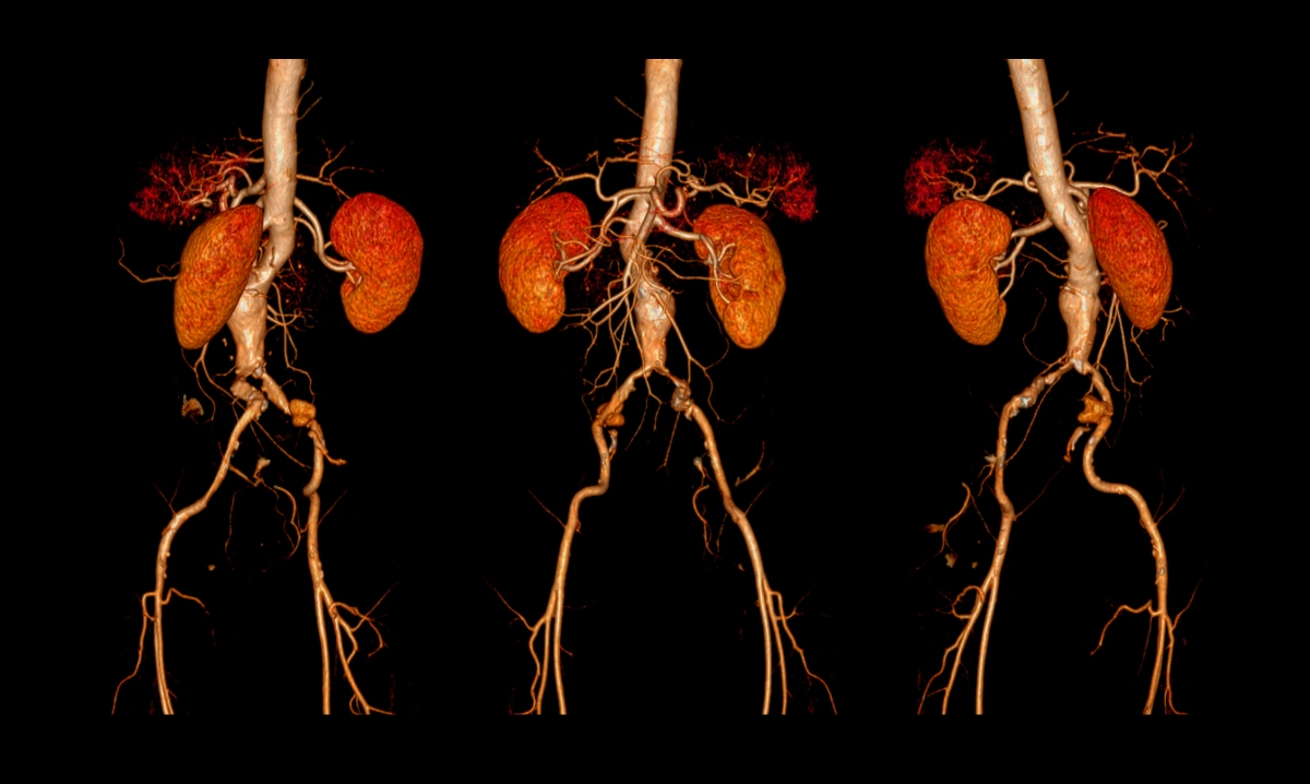 A CT angiography of the abdominal aorta to represent an abdominal aortic aneurysm and the potential of metformin as a pharmacological intervention