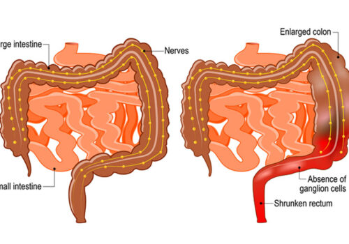 Side-by-side medical diagrams of the intestines comparing a normal colon with one affected by Hirschsprung disease, highlighting enlarged colon sections, absence of ganglion cells, and a shrunken rectum to illustrate a potential new stem cell therapy to transform care