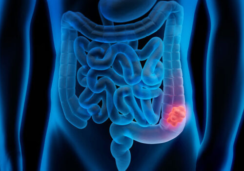 Overall uptake of CT colonography screening low but higher among ethnic minorities
