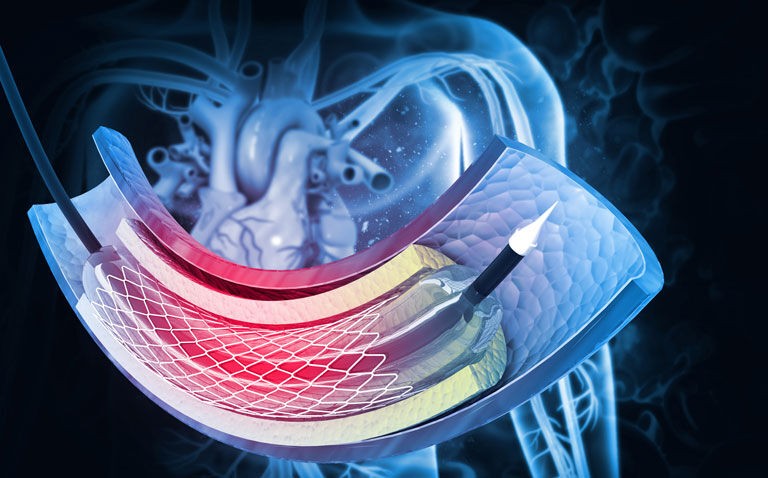 P2Y12 inhibitor mono-therapy after PCI