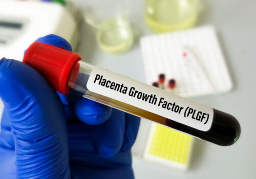 PLGF-based testing recommended for suspected preterm pre-eclampsia