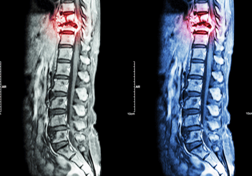 Prophylactic irradiation of asymptomatic bone metastases reduces skeletal-related events