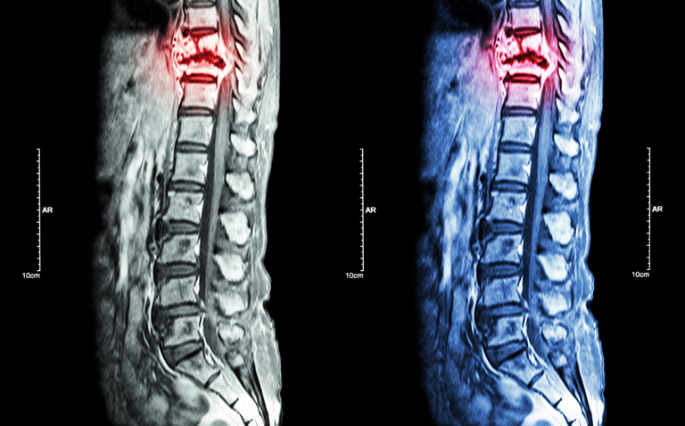 Prophylactic irradiation of asymptomatic bone metastases reduces skeletal-related events