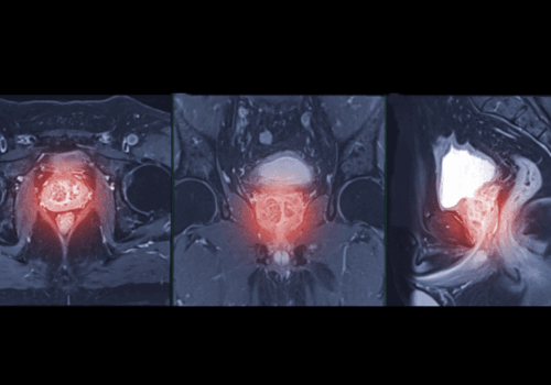 Prostate cancer screening with MRI after PSA a cost-effective strategy