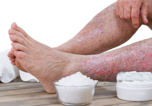 Psoriasis patients self-report higher analgesic usage largely due to joint pain