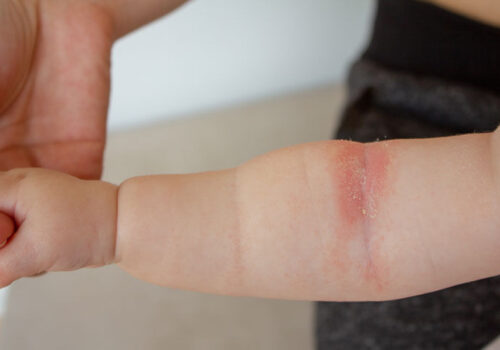 RCT finds dupilumab effective for children under six with atopic eczema