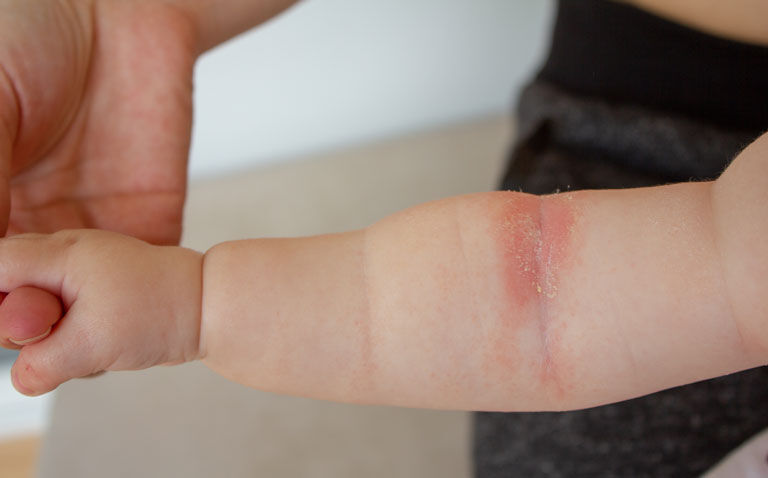 RCT finds dupilumab effective for children under six with atopic eczema