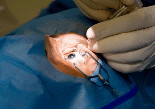 RCT finds no reduction in cataract surgery after long-term high-dose vitamin D