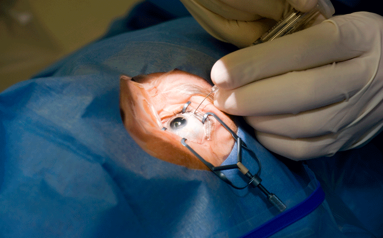 RCT finds no reduction in cataract surgery after long-term high-dose vitamin D