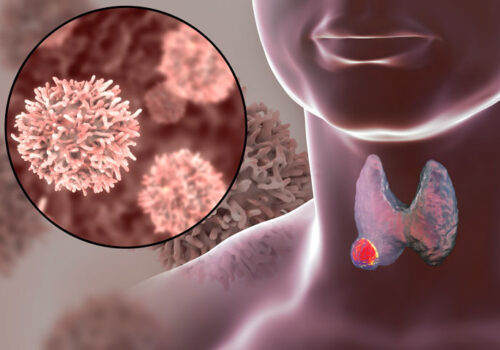 Radiofrequency ablation effective for low-risk thyroid papillary microcarcinoma